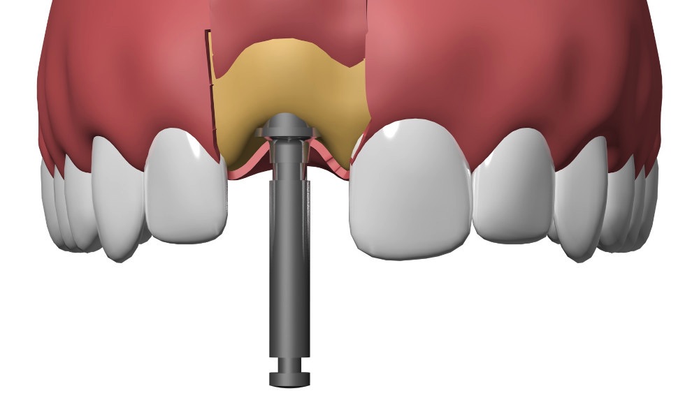 Implant dentaire Nimes Nicolas Henner